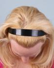 After Hair Transplant&nbsp;Hairline